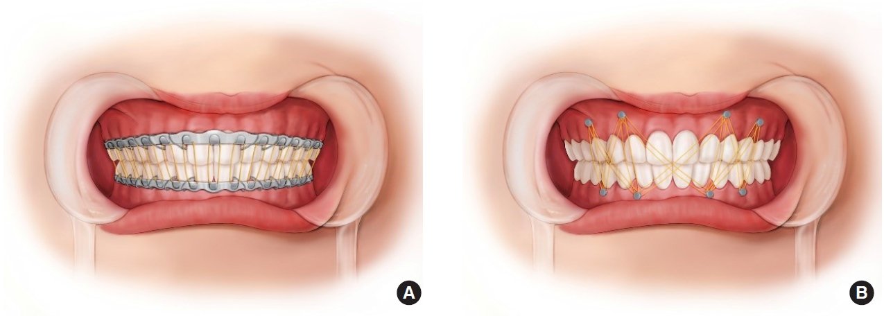 Dental IMF in Varanasi
