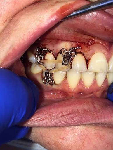 Dental IMF in Varanasi