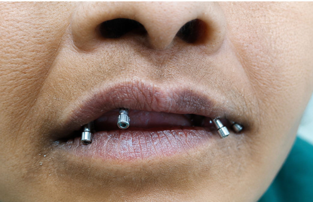 Dental Implants in Varanasi