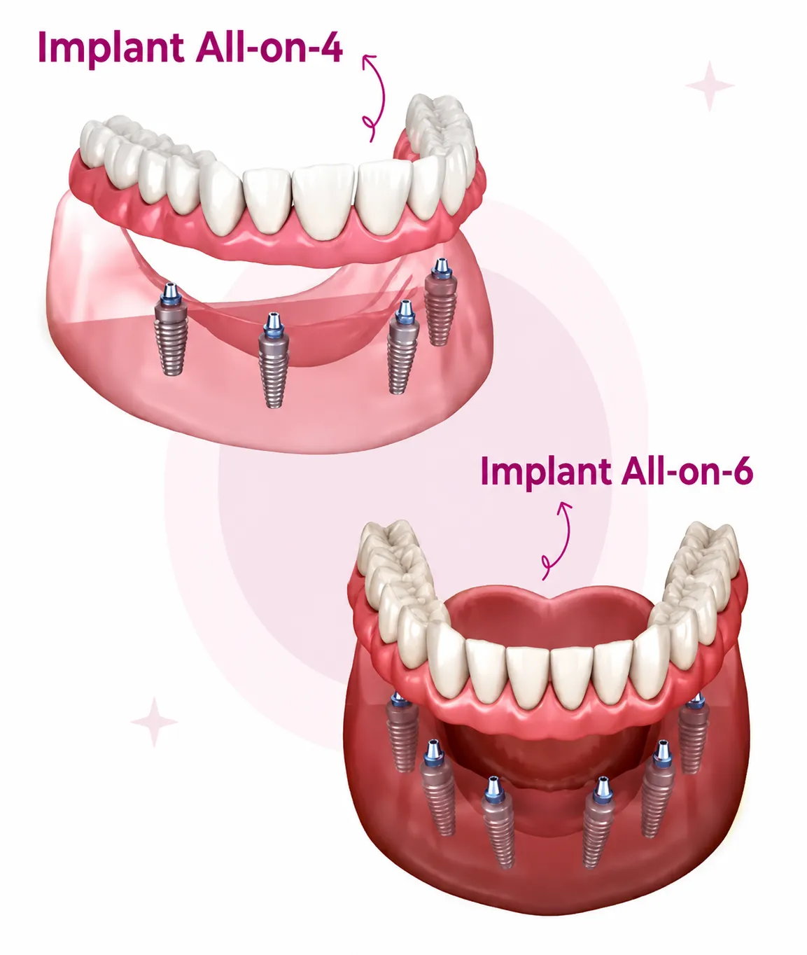 Dental Implants in Varanasi