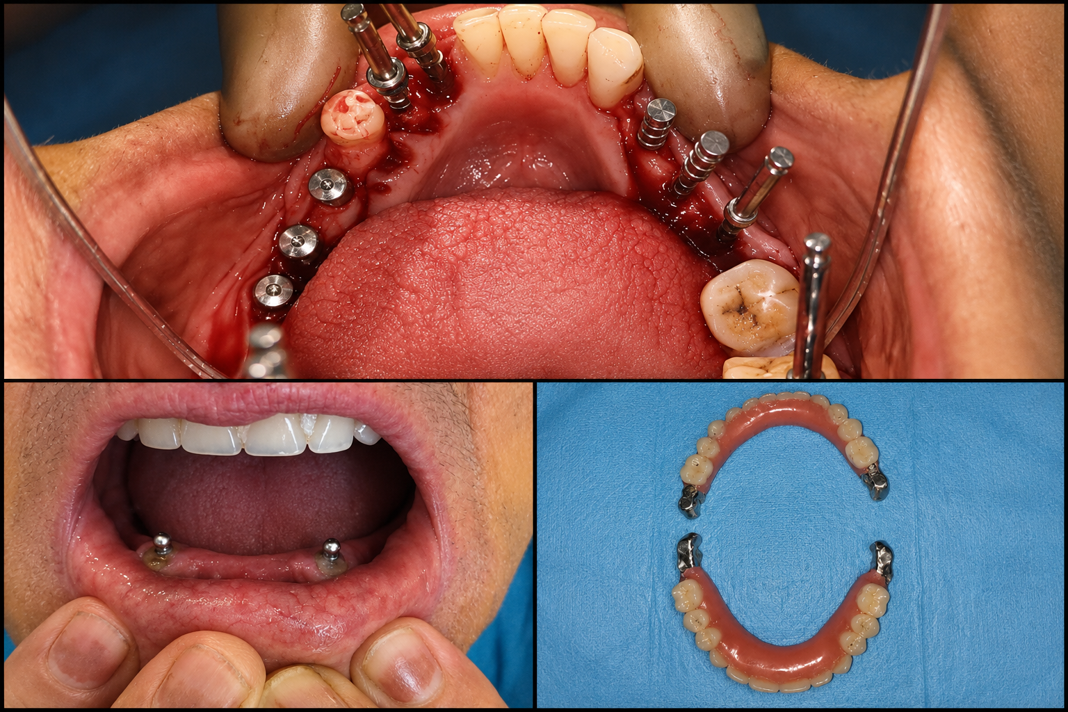 Dental Implants in Varanasi
