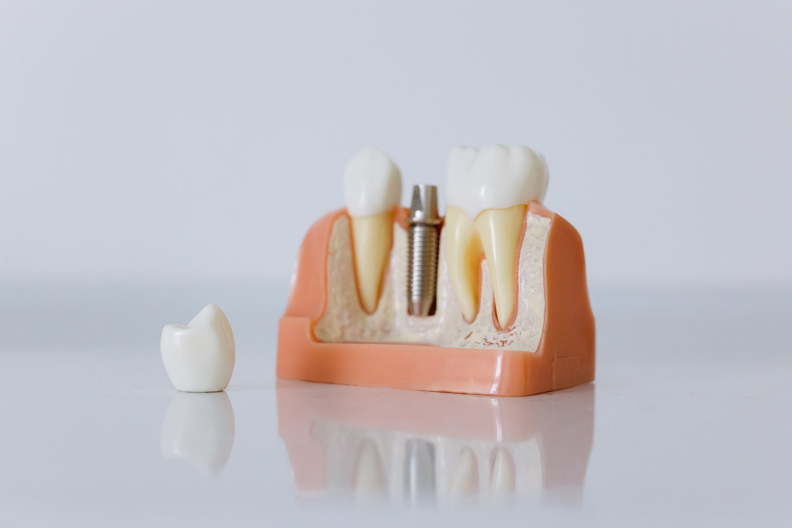 Clinical imagery of a titanium dental implant