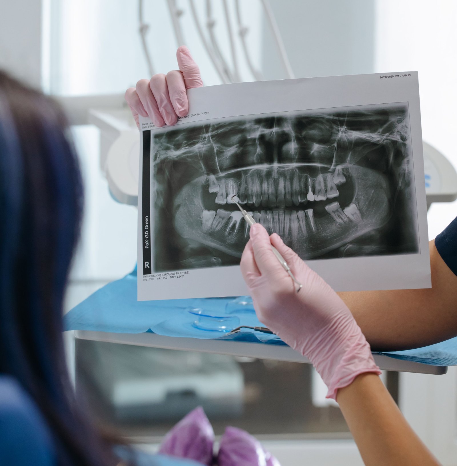 Surgical Tooth Extraction in Varanasi