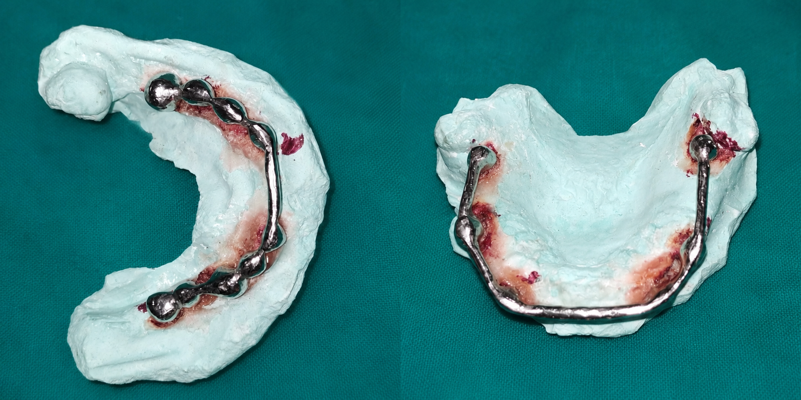 Dental Implants in Varanasi