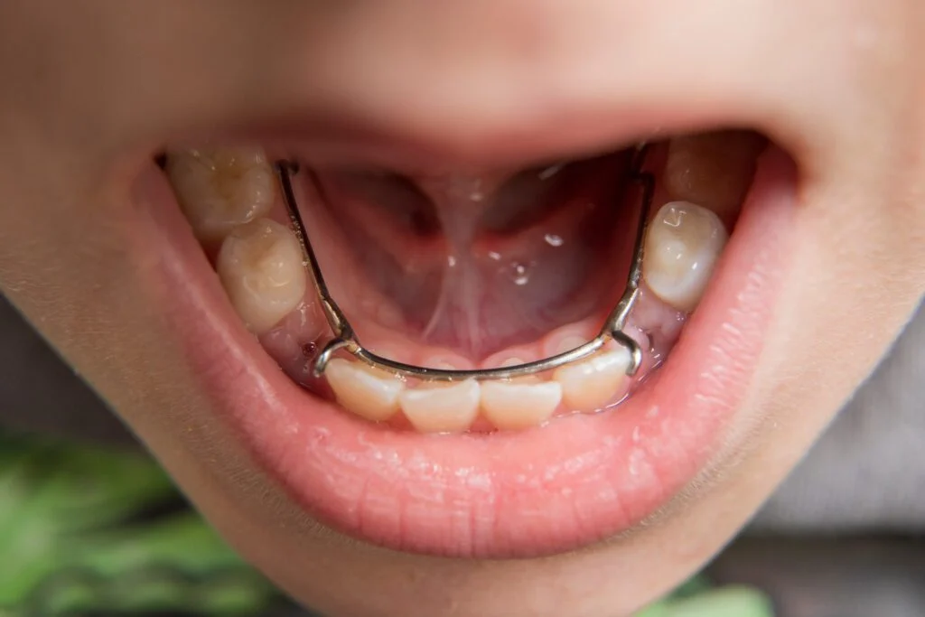 Child smiling showing early interceptive orthodontic care