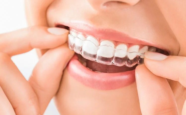 Dental Aligners in Varanasi