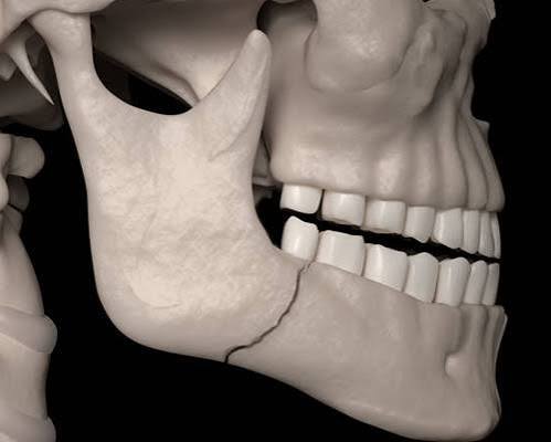 Maxilla and Mandible Fractures