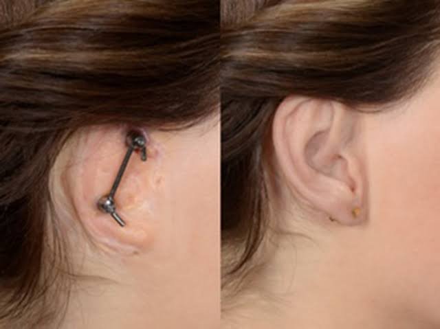Auricular Prosthesis in Varanasi