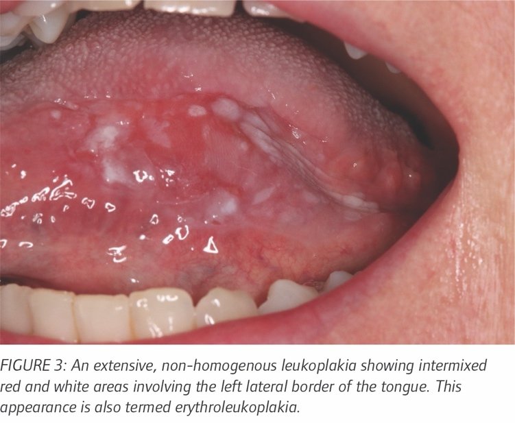 Laser ablation treatment for oral lesions