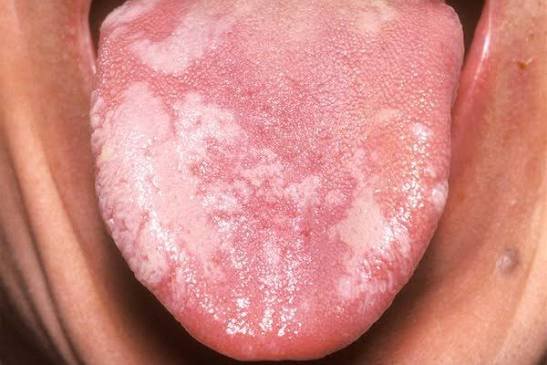 Leukoplakia Treatment in Varanasi