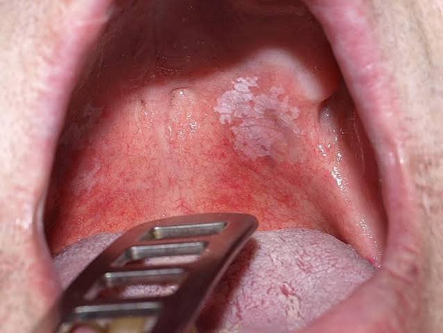 Clinical presentation of oral white patches