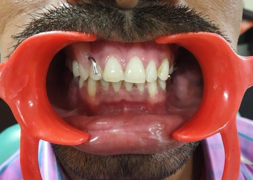 Maxillofacial Rehabilitation