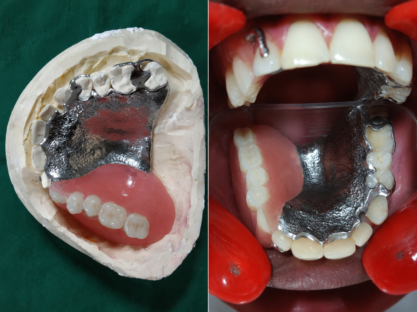 maxillofacial rehabilitation in Varanasi
