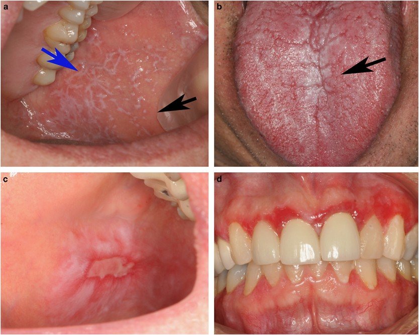 Lacy white patches characteristic of OLP