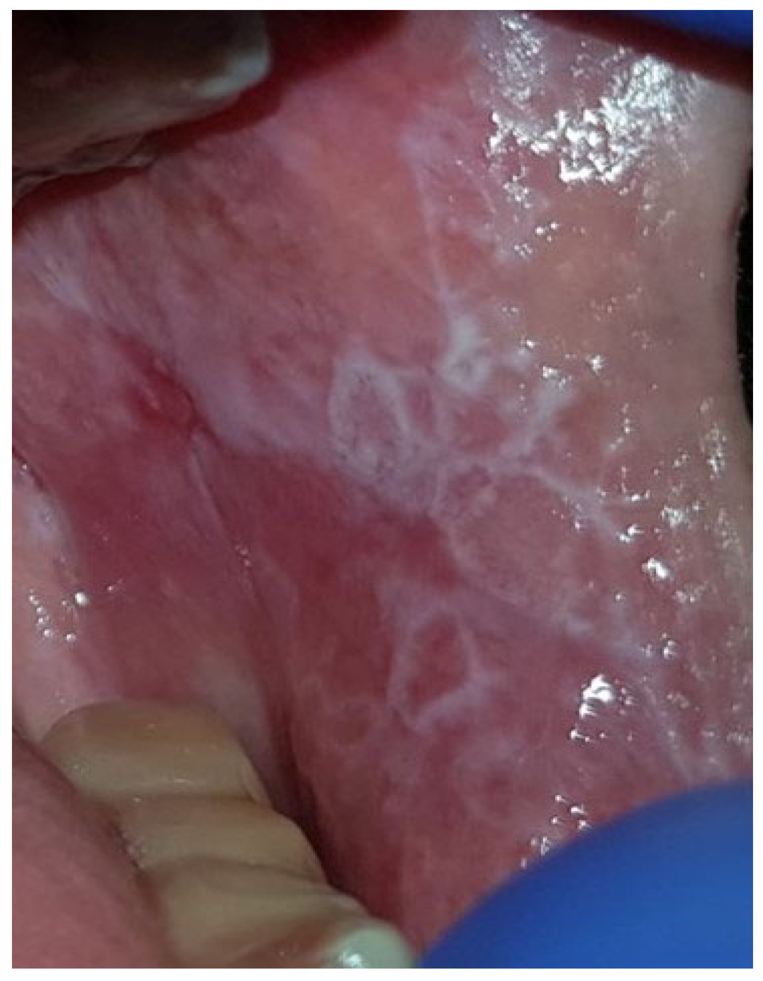 Oral Lichen Planus