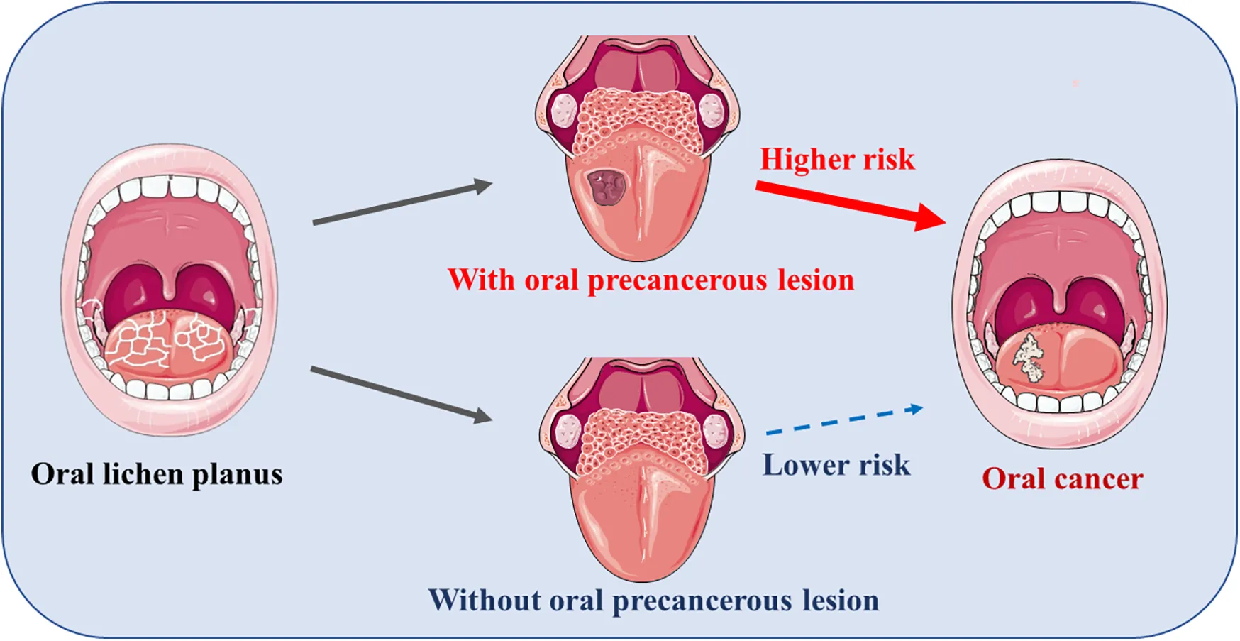 Erosive Form of OLP
