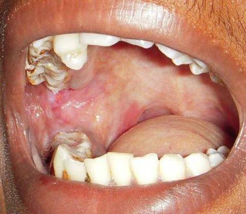 Clinical imagery of oral cavity examination for OSMF