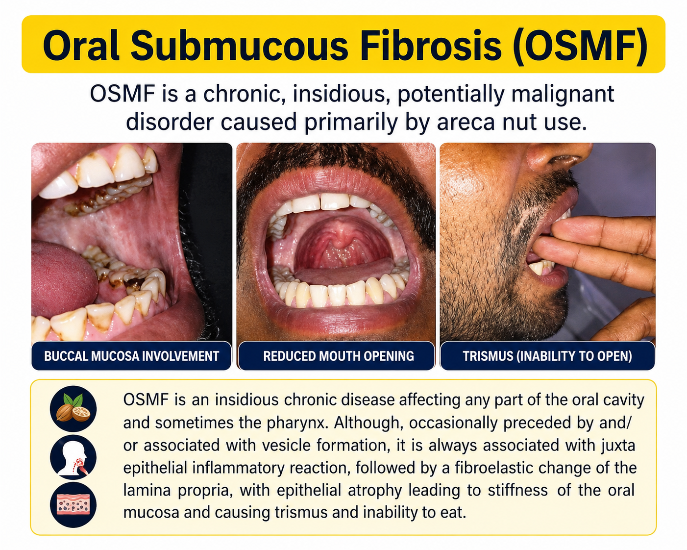 Fibrous Bands causing Trismus