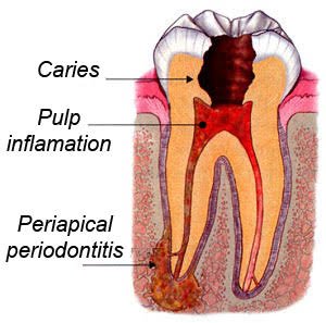 Clinical imagery of a periapical infection