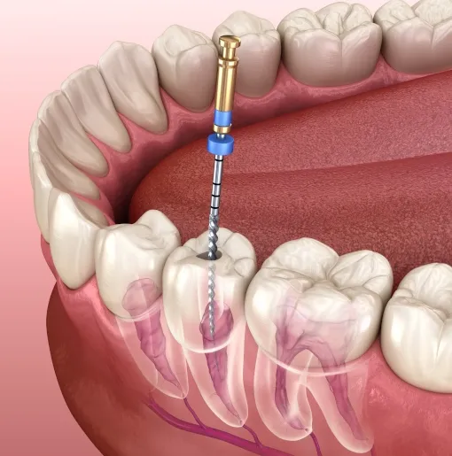 Painless Root Canal Treatment