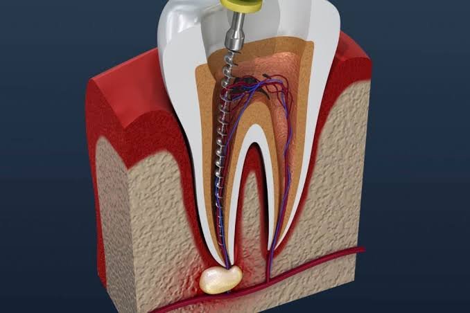 Clinical imagery of a root canal procedure