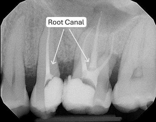 Dental RCT in Varanasi