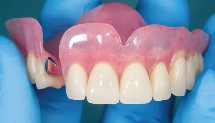 Dental Implants in Varanasi