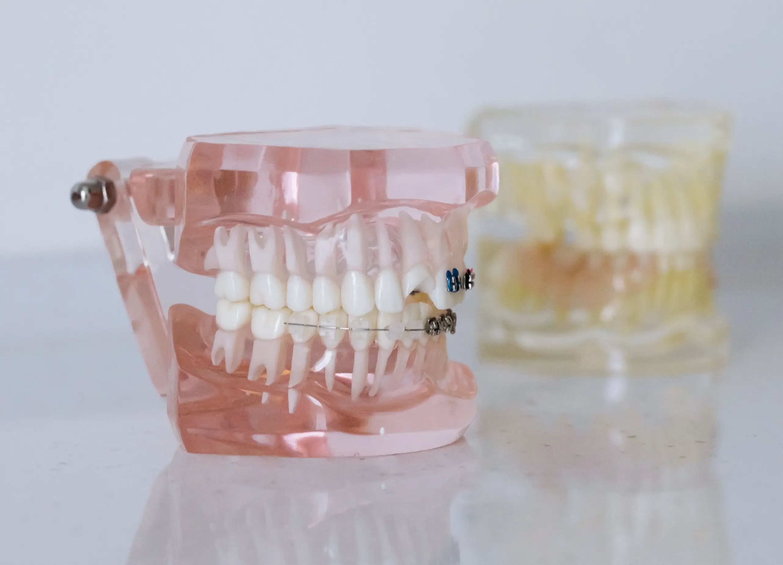 Removable Braces