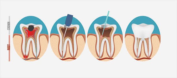Dental Implants in Varanasi