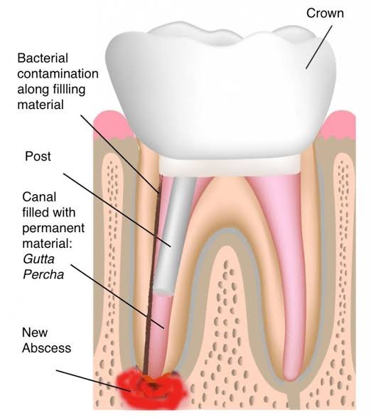 Radiographic view of a failed root canal requiring retreatment