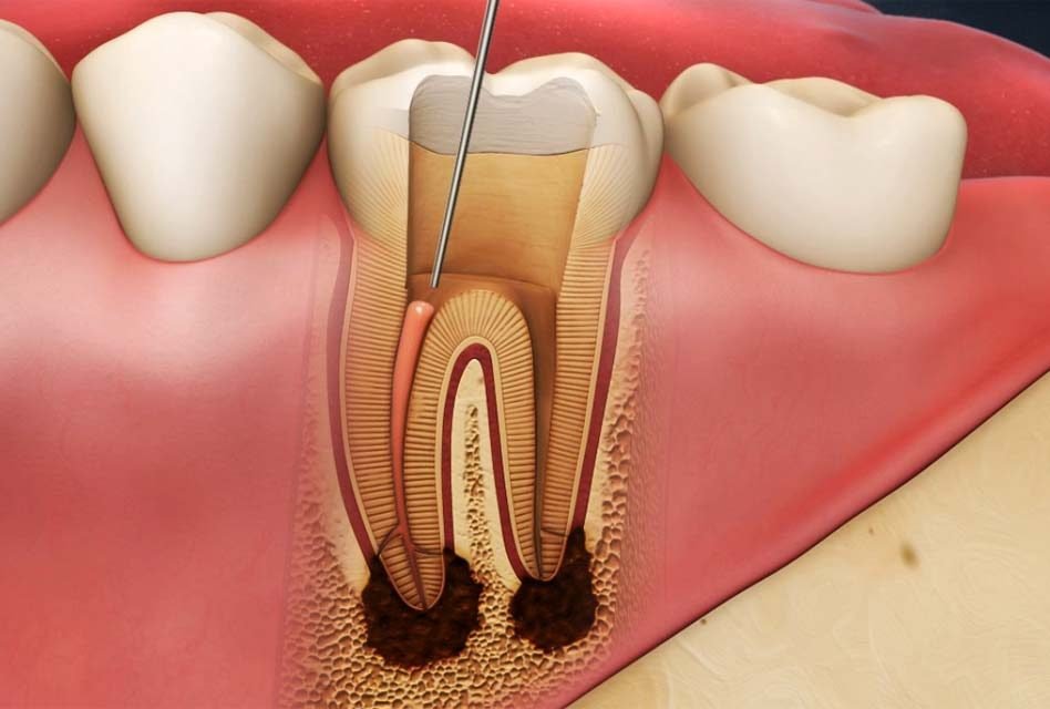 Clinical imagery of endodontic retreatment