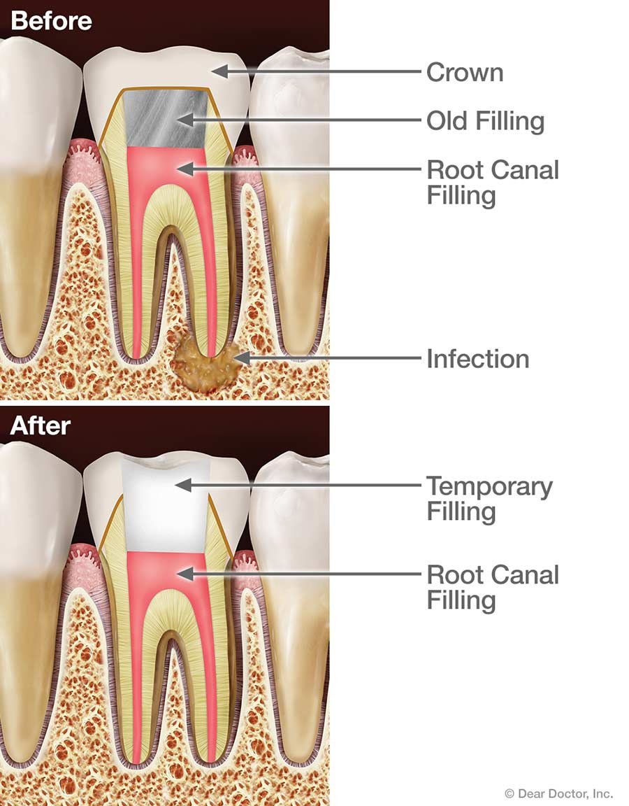 Radiographic view of a failed root canal requiring retreatment