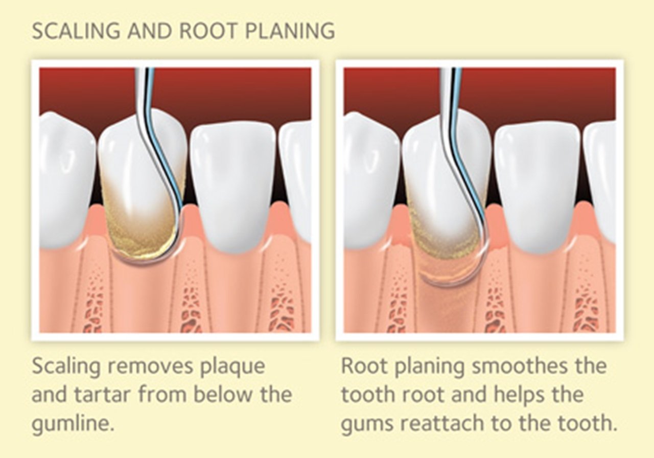 Dental Scaling in Varanasi