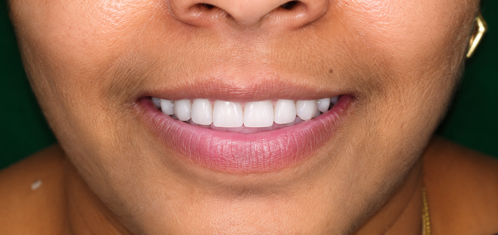 Smile Designing in Varanasi