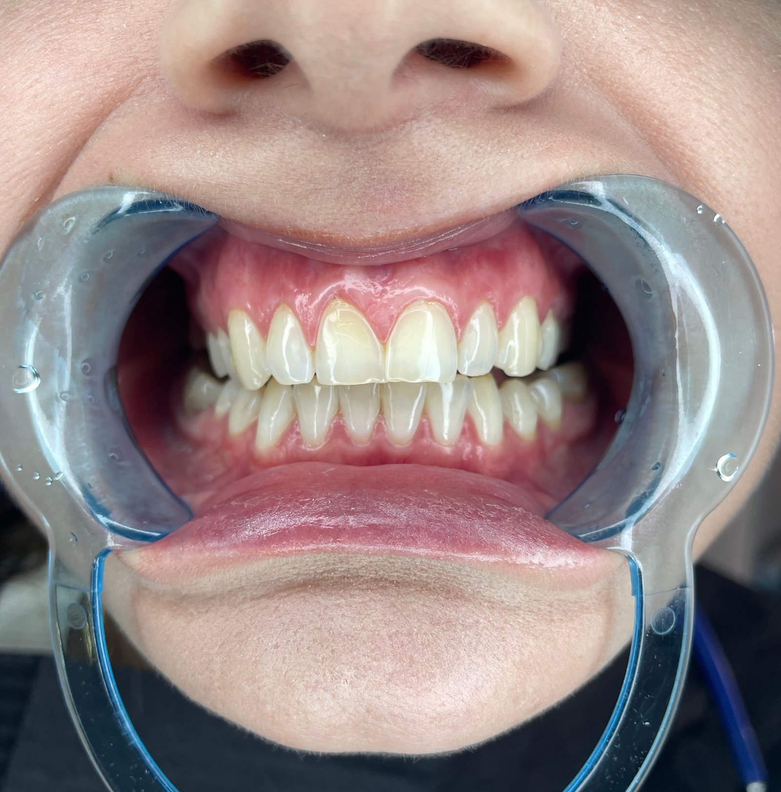 Patient undergoing professional teeth whitening