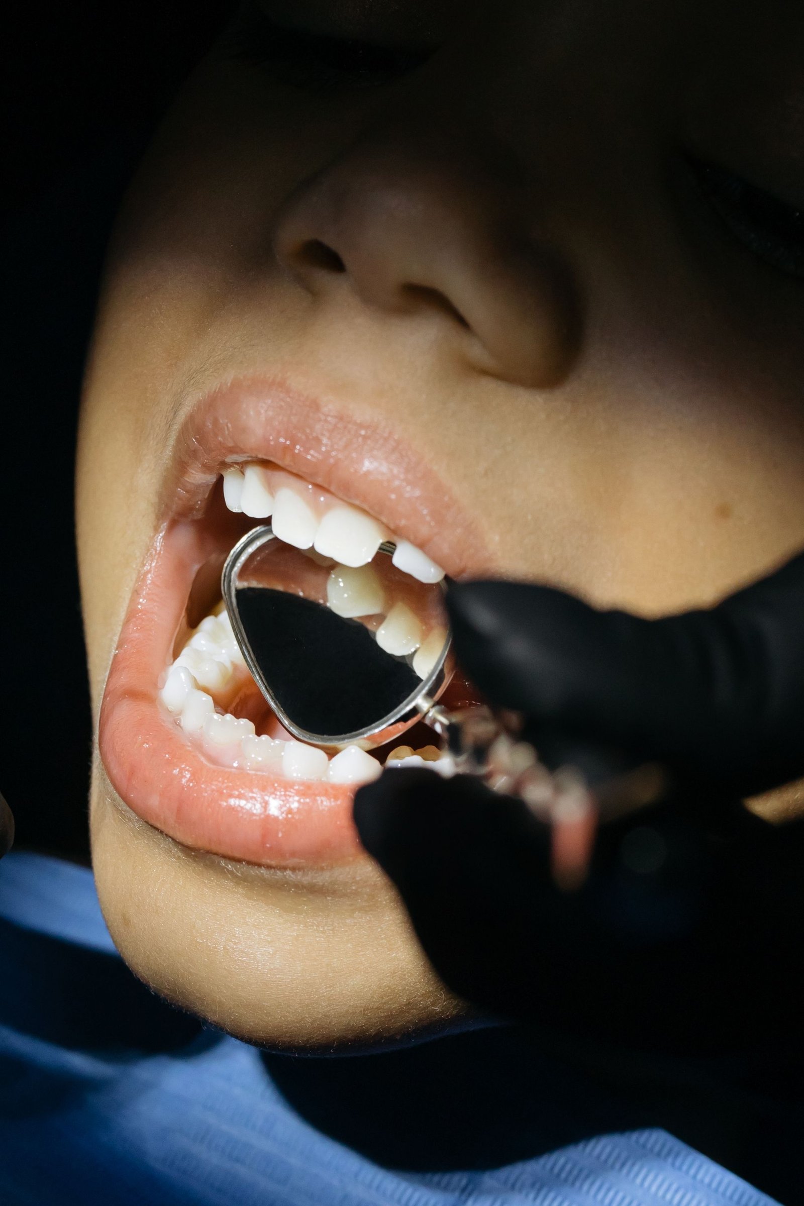 Post-Oral Cancer Prosthesis