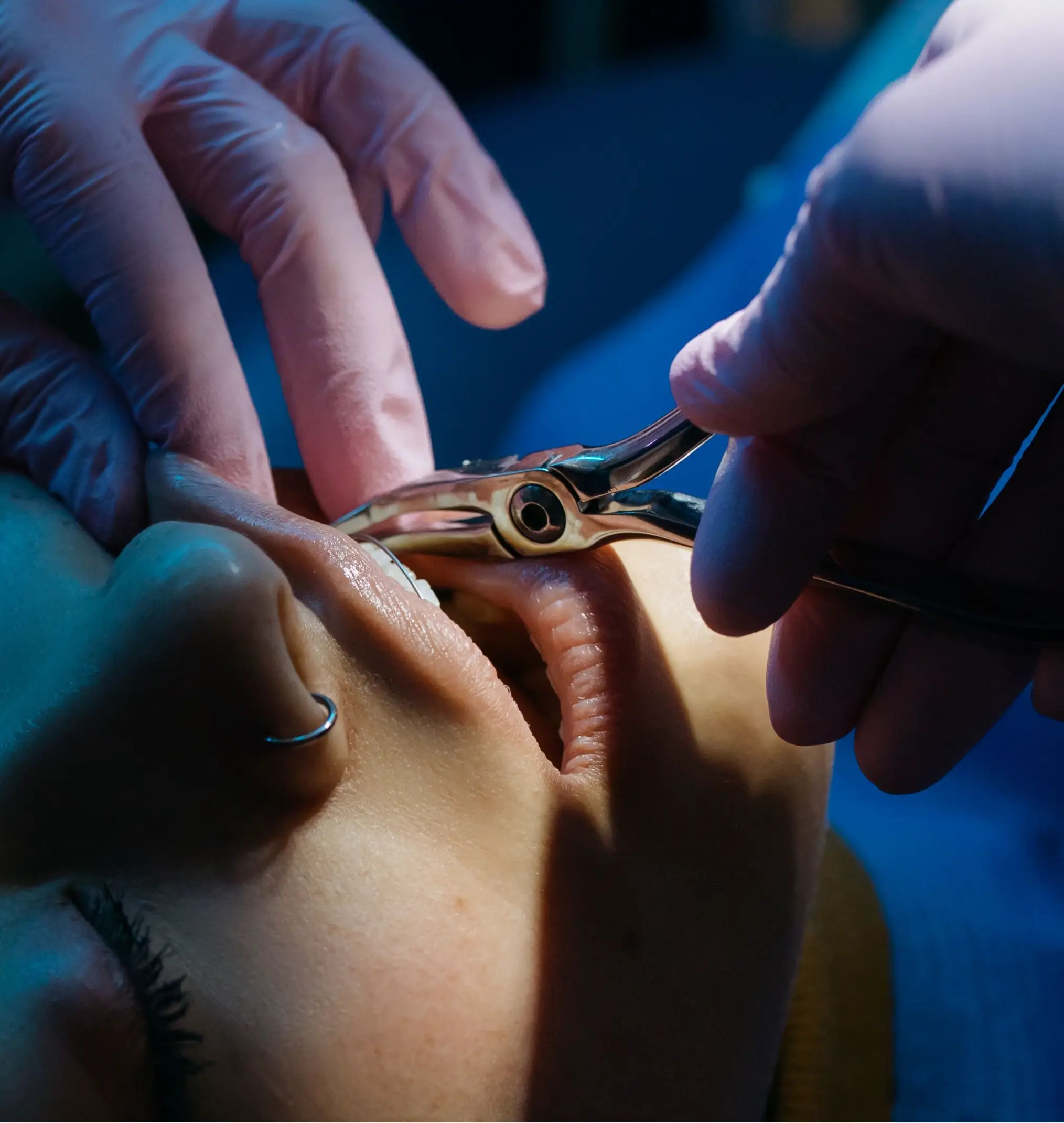 Tooth Extraction