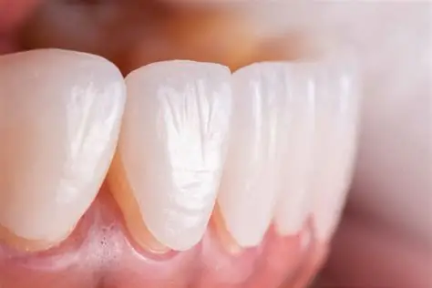 veneers-in-varanasi