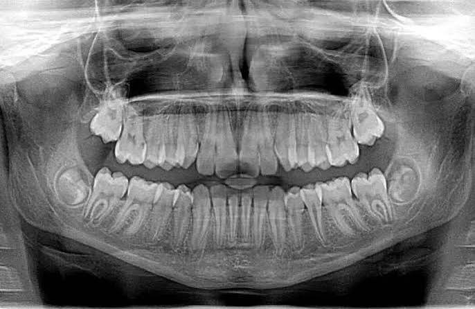 High contrast digital dental radiograph showing tooth roots