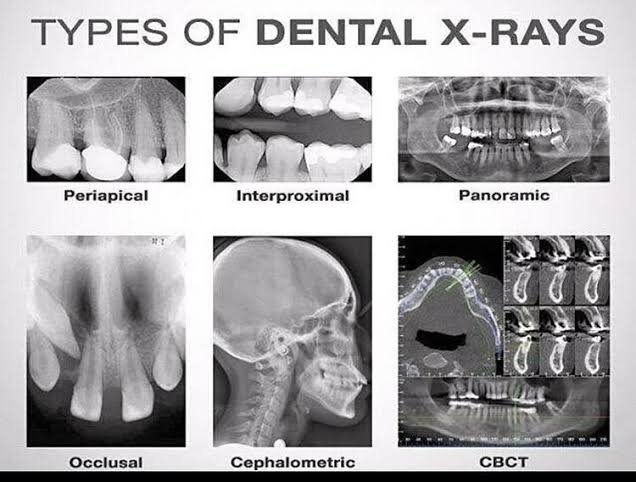 High contrast digital dental radiograph showing tooth roots